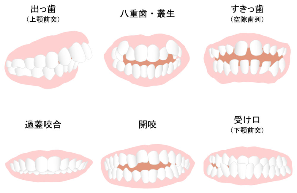 成人矯正について